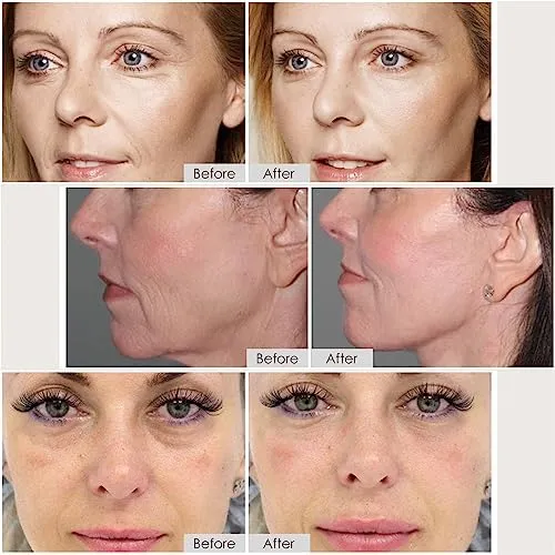 Lefay Radio Frequency Skin Tightening Face Machine