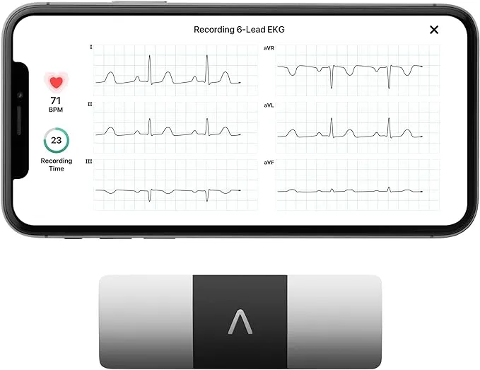 KardiaMobile 6-Lead Personal EKG Monitor – Six Views of The Heart – Detects AFib and Irregular Arrhythmias – Instant Results in 30 Seconds – Works with Most Smartphones - FSA/HSA Eligible